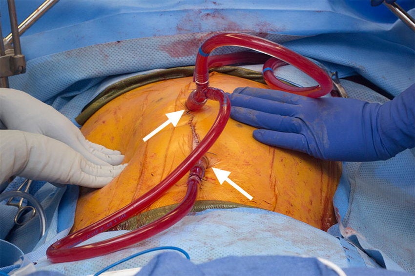 Hyperthermic Intraperitoneal Chemotherapy